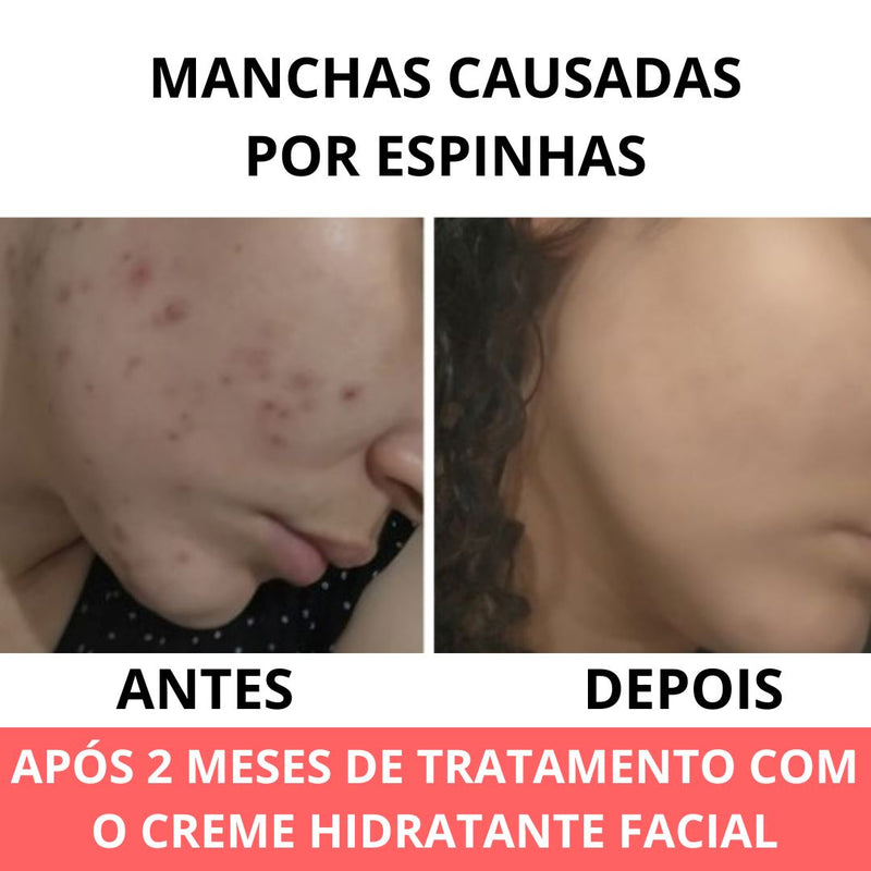 Creme Hidratante Facial | Anti Rugas